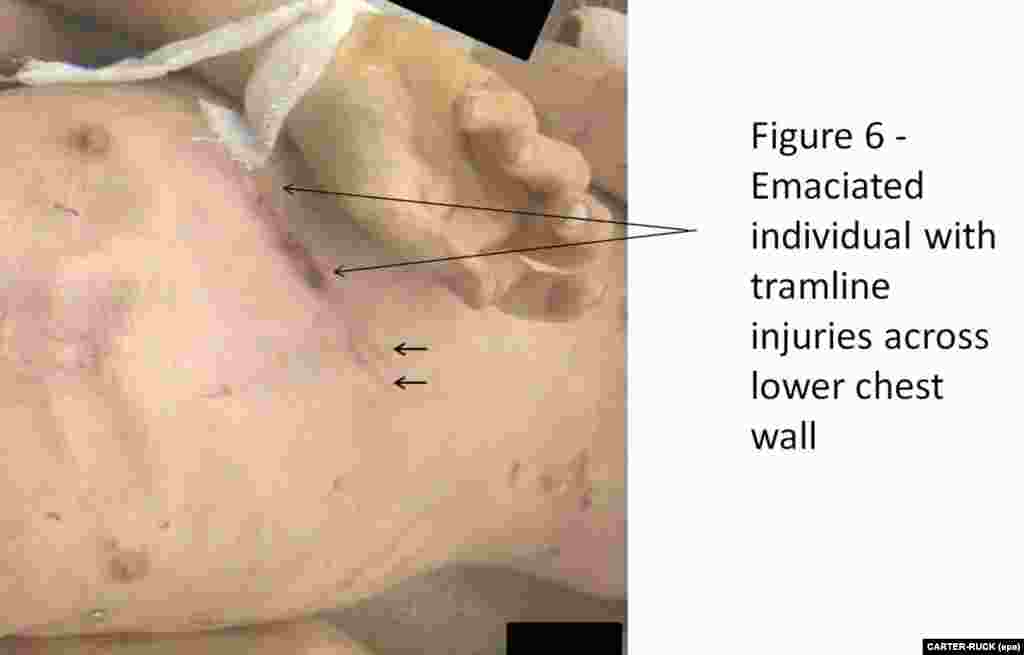 An undated photograph showing an emaciated indvidual with injuries across the lower chest.